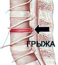 САМЕ остеохондроз (захворювання хряща міжхребцевого диска) є причиною болю в спині в 80% випадків